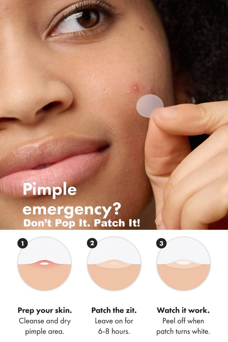 Pimples patch 1.0