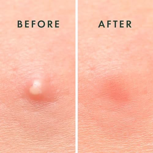 Pimples patch 1.0