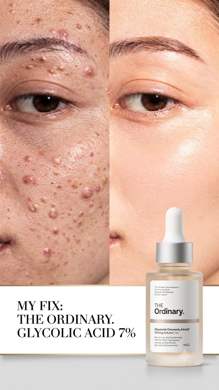 The Ordinary Niacinamide 10% + Zinc 1% High-Strength Blemish Formula